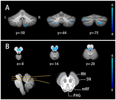 Structural and functional changes of the cerebellum in temporal lobe epilepsy